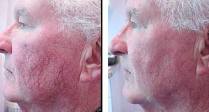 beauty-salon-hamilton-facial-vessels