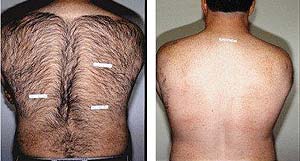 beauty-salon-hamilton-hair-removal